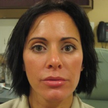 Botox in Saratoga, California